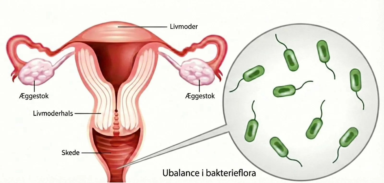 Illustration af ubalance i bakteriefloraen i skeden ved bakteriel vaginose