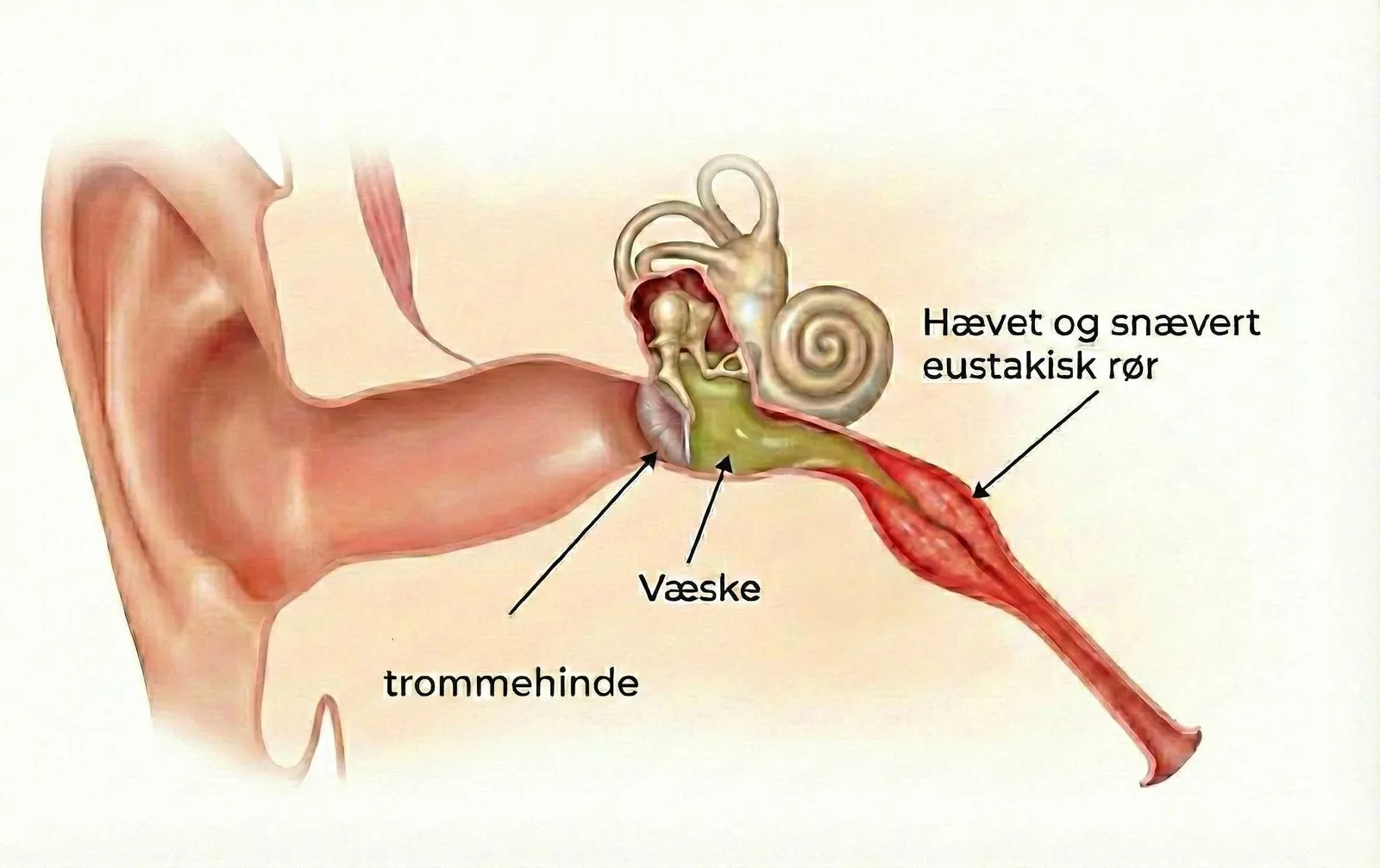 Illustration af væske i mellemøret